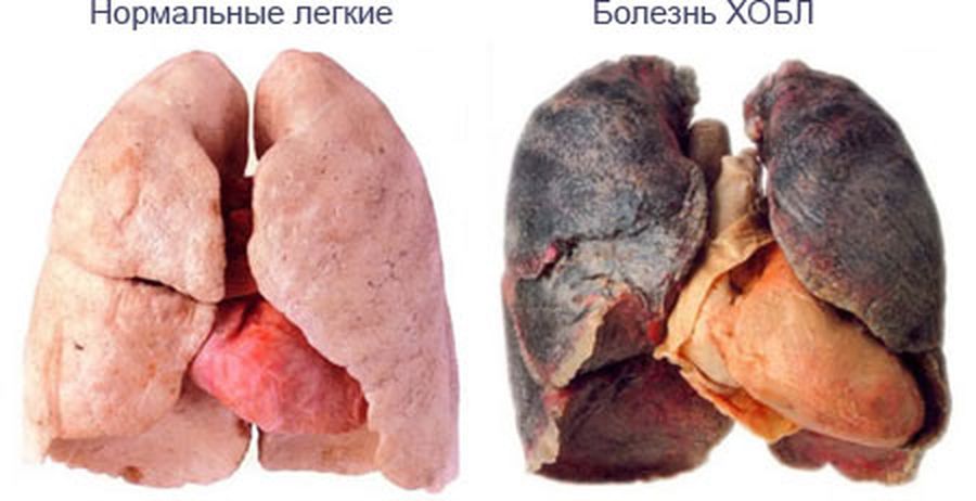 Обструкция легких: скрытая угроза